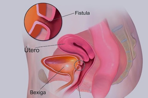Incontinência Urinária