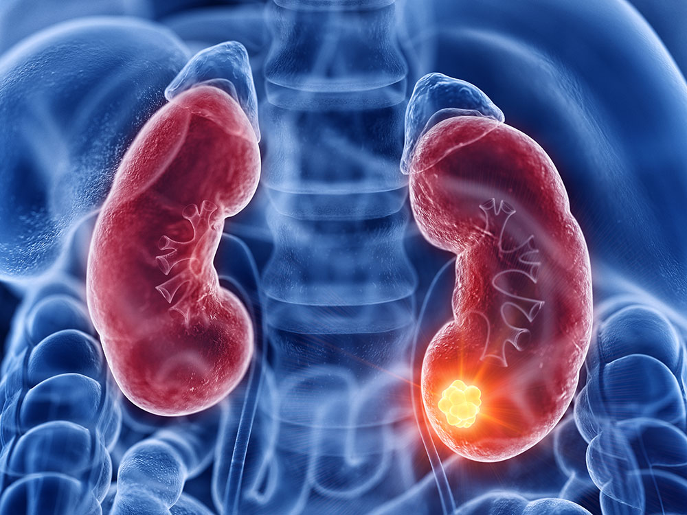 Oncologia Urológica