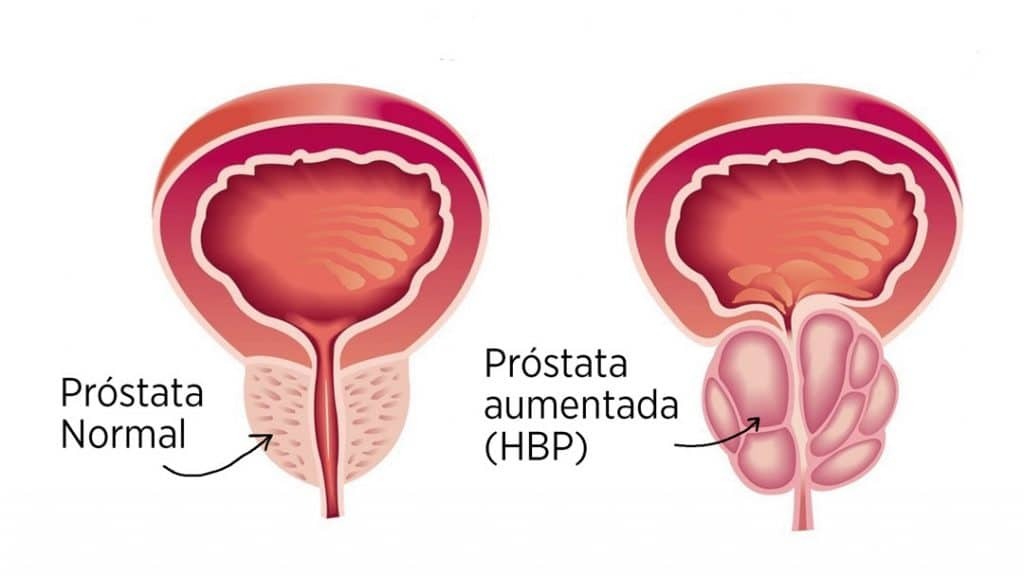 Próstata